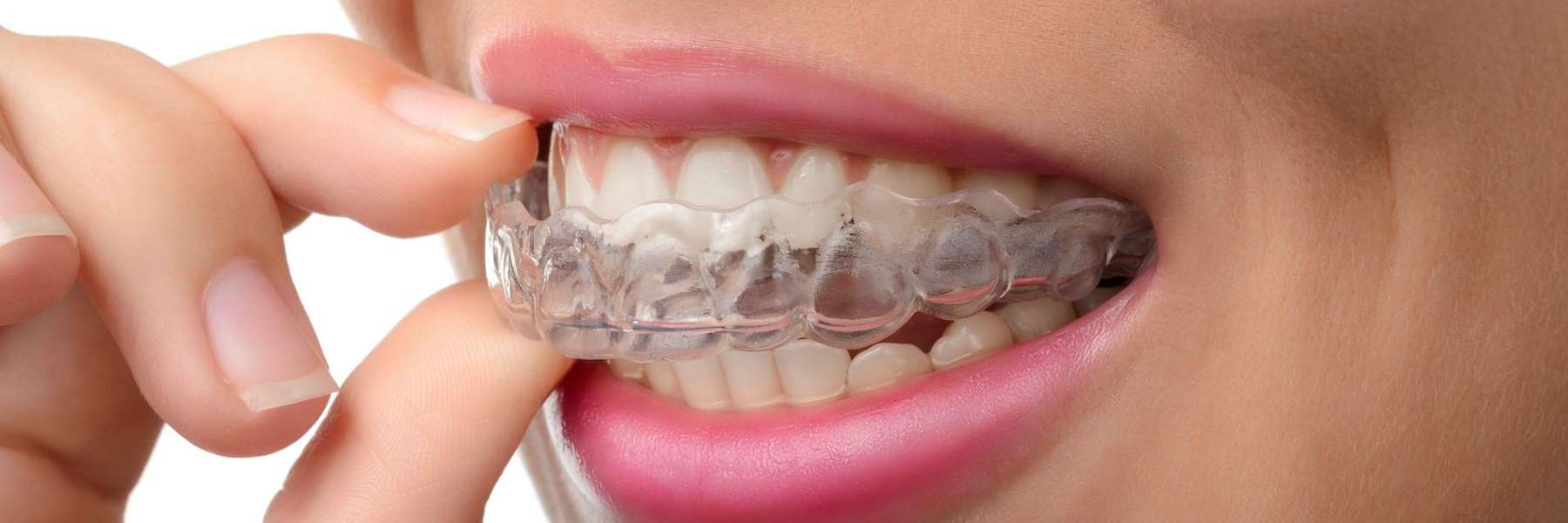 Invisalign for Adults