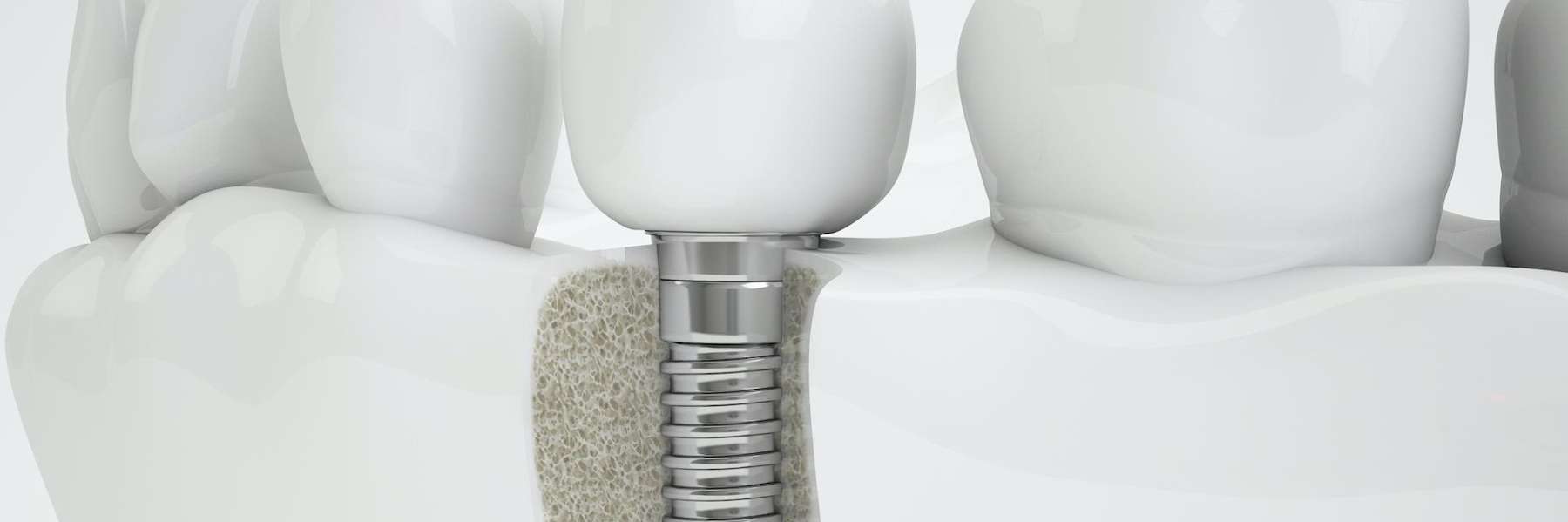 dental implant restoration after damage