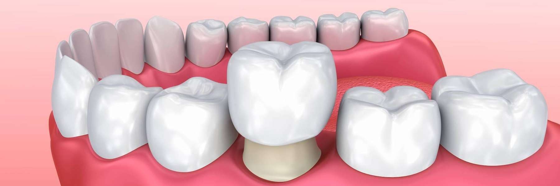 dental crown in west chester oh
