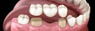 Dental Crowns