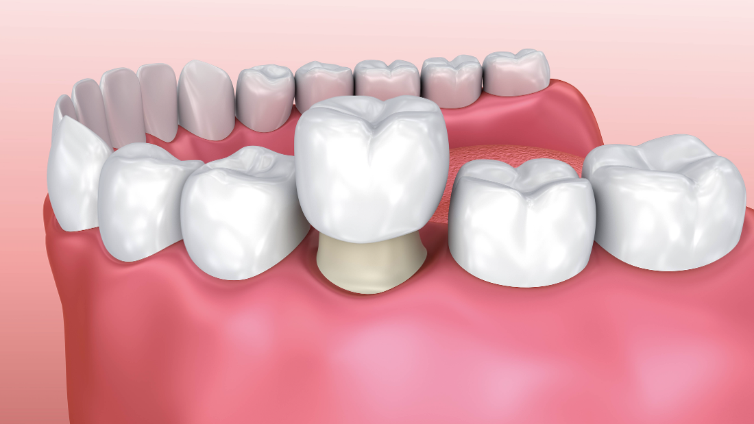 The Dental Crown Process Crowns & Bridges West Chester OH